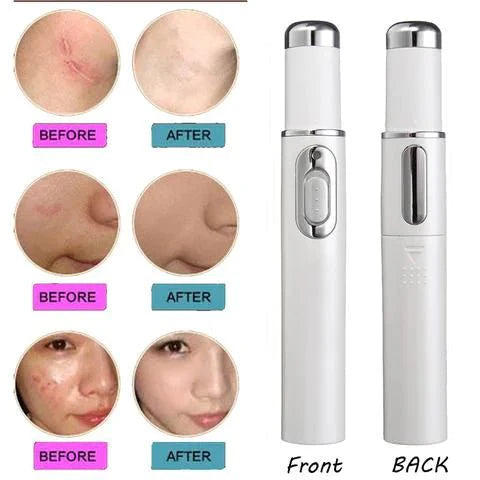 Blue Light Therapy Acne Pen with Heat & Microcurrent